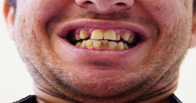 crooked-teeth-g0308f3d84_1920_0.jpg